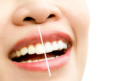 Tratamiento de Blanqueamiento Dental